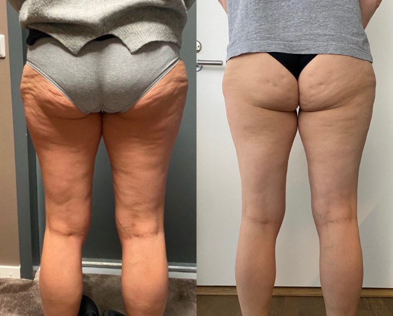 Före och efter behandling av lår och rumpa